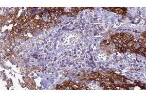 ABIN6277924 at 1/100 staining Human Head and neck cancer tissue by IHC-P.