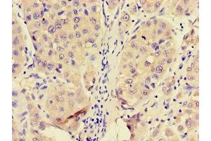 Immunohistochemistry of paraffin-embedded human liver cancer using ABIN7144950 at dilution of 1:100 (PFKL Antikörper  (AA 229-479))