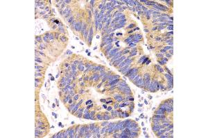 Immunohistochemistry of paraffin-embedded human colon carcinoma using HMGCL antibody (ABIN5975709) at dilution of 1/100 (40x lens). (HMGCL Antikörper)