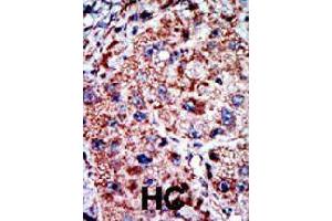 Formalin-fixed and paraffin-embedded human hepatocellular carcinoma tissue reacted with PFKL polyclonal antibody  , which was peroxidase-conjugated to the secondary antibody, followed by AEC staining.