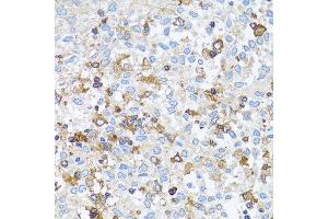 Immunohistochemistry of paraffin-embedded human lung cancer using ACTR2 antibody. (ACTR2 Antikörper  (AA 1-160))