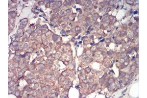 Immunohistochemical analysis of paraffin-embedded breast cancer tissues using IRAK3 mouse mAb with DAB staining.