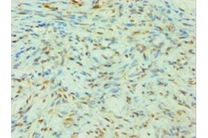 Immunohistochemistry of paraffin-embedded human breast cancer using ABIN7144142 at dilution of 1:100 (SLC4A2 Antikörper  (AA 95-245))