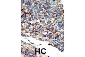 Formalin-fixed and paraffin-embedded human cancer tissue reacted with the primary antibody, which was peroxidase-conjugated to the secondary antibody, followed by AEC staining. (PI3KC2G Antikörper  (N-Term))