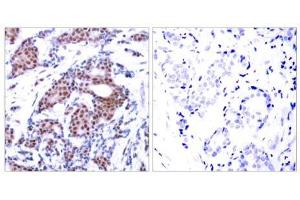 Immunohistochemical analysis of paraffin-embedded human breast carcinoma tissue using Elk-1 (phospho-Ser383) antibody (E011004). (ELK1 Antikörper  (pSer383))