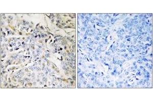 Immunohistochemistry analysis of paraffin-embedded human breast carcinoma tissue, using RBM34 Antibody. (RBM34 Antikörper  (AA 345-394))
