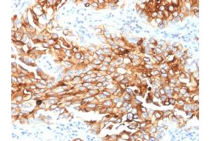 Immunohistochemistry (IHC) image for anti-Mesothelin (MSLN) (AA 273-407) antibody (ABIN6939032)