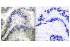 Immunohistochemical analysis of paraffin-embedded human lung carcinoma tissue using Guanylate Cyclase beta antibody (ABIN5976418). (GUCYB Antikörper  (N-Term))