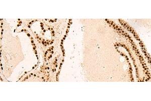 Immunohistochemistry of paraffin-embedded Human thyroid cancer tissue using SNRPB2 Polyclonal Antibody at dilution of 1:75(x200) (SNRPB2 Antikörper)