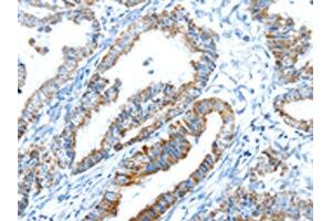 The image on the left is immunohistochemistry of paraffin-embedded Human esophagus cancer tissue using ABIN7192908(TRIM47 Antibody) at dilution 1/20, on the right is treated with synthetic peptide. (TRIM47 Antikörper)
