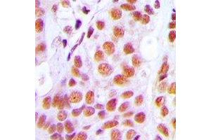 Immunohistochemical analysis of PRPF3 staining in human breast cancer formalin fixed paraffin embedded tissue section.