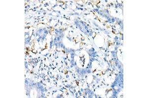 Immunohistochemistry of paraffin-embedded Human colon carcinoma using CD74 antibody (ABIN6128421, ABIN6138228, ABIN6138230 and ABIN6221316) at dilution of 1:25 (40x lens). (CD74 Antikörper  (AA 73-232))