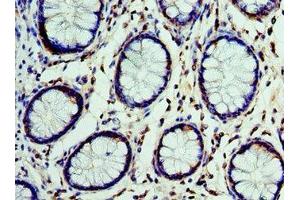 Immunohistochemistry of paraffin-embedded human colon cancer using ABIN7149003 at dilution of 1:100