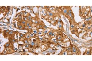 Immunohistochemistry of paraffin-embedded Human breast cancer using LTF Polyclonal Antibody at dilution of 1:40 (Lactoferrin Antikörper)