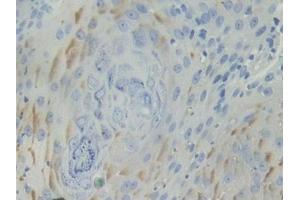 DAB staining on IHC-P; Samples: Human Skin cancer Tissue (BCAM Antikörper  (AA 32-257))