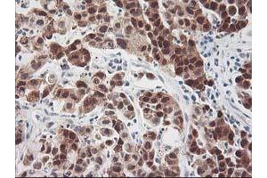 Immunohistochemical staining of paraffin-embedded Carcinoma of Human lung tissue using anti-HSPBP1 mouse monoclonal antibody. (HSPBP1 Antikörper)