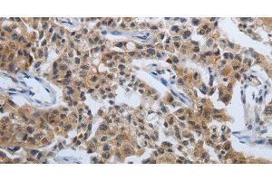 Immunohistochemistry of paraffin-embedded Human lung cancer tissue using PDCD7 Polyclonal Antibody at dilution 1:60 (PDCD7 Antikörper)