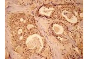 Immunohistochemistry analysis of human breast cancer tissue with MEK1 pAb. (MEK1 Antikörper  (N-Term))