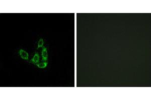 Peptide - +Immunohistochemistry analysis of paraffin-embedded human liver carcinoma tissue using GCNT3 antibody. (GCNT3 Antikörper)