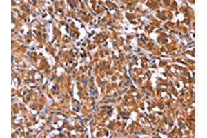 The image on the left is immunohistochemistry of paraffin-embedded Human thyroid cancer tissue using ABIN7192753(TDP2 Antibody) at dilution 1/40, on the right is treated with synthetic peptide. (TDP2 Antikörper)