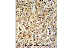 DDX6 Antibody (Center) (ABIN653855 and ABIN2843115) IHC analysis in formalin fixed and paraffin embedded breast carcinoma followed by peroxidase conjugation of the secondary antibody and DAB staining. (DDX6 Antikörper  (AA 348-375))