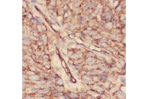 Anti-CD34 Picoband antibody,  IHC(P): Human Lung Cancer Tissue (CD34 Antikörper  (AA 151-385))