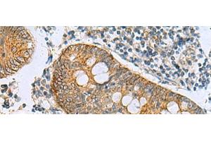 Immunohistochemistry of paraffin-embedded Human colorectal cancer tissue using GUCA1A Polyclonal Antibody at dilution of 1:105(x200)