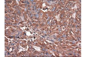 Immunohistochemical staining of paraffin-embedded Adenocarcinoma of breast using anti-CPA1 (ABIN2452647) mouse monoclonal antibody. (CPA1 Antikörper  (AA 1-419))