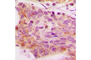 Immunohistochemical analysis of NFAT4 (pS165) staining in human breast cancer formalin fixed paraffin embedded tissue section.