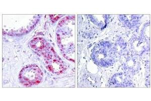 Immunohistochemical analysis of paraffin-embedded human breast carcinoma tissue using c-Jun(Phospho-Ser243) Antibody(left) or the same antibody preincubated with blocking peptide(right). (C-JUN Antikörper  (pSer243))