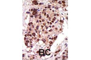 Formalin-fixed and paraffin-embedded human cancer tissue reacted with the PRKD3 polyclonal antibody  , which was peroxidase-conjugated to the secondary antibody, followed by AEC staining .