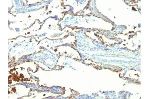 Formalin-fixed, paraffin-embedded human Lung Carcinoma stained with Milk Fat Globule Monoclonal Antibody (SPM291) (MFGE8 Antikörper)