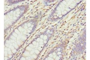 Immunohistochemistry of paraffin-embedded human colon cancer using ABIN7175357 at dilution of 1:100