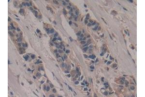 IHC-P analysis of Human Breast cancer Tissue, with DAB staining. (Poliovirus Receptor Antikörper  (AA 56-309))