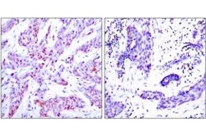 Immunohistochemistry analysis of paraffin-embedded human breast carcinoma, using ATF4 (Ab-245) Antibody. (ATF4 Antikörper  (AA 212-261))