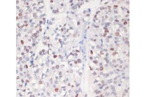 Immunohistochemistry of paraffin-embedded Human gastric cancer using Phospho-γH2A. (gamma H2AX Antikörper  (pSer139))