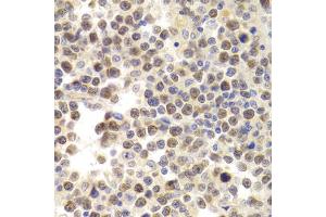 Immunohistochemistry of paraffin-embedded human B cell lymphoma using MCM4 Antibody (ABIN5971548) at dilution of 1/200 (40x lens). (MCM4 Antikörper)