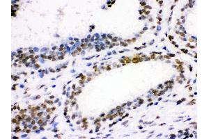 Anti- CDK1 Picoband antibody, IHC(P) IHC(P): Human Mammary Cancer Tissue (CDK1 Antikörper  (AA 66-297))
