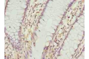 Immunohistochemistry of paraffin-embedded human colon cancer using ABIN7163544 at dilution of 1:100 (PLGRKT Antikörper  (AA 1-147))