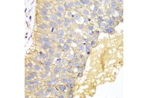 Immunohistochemistry of paraffin-embedded human lung cancer using EPCAM antibody (ABIN5970523) at dilution of 1/100 (40x lens). (EpCAM Antikörper)