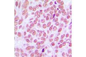 Immunohistochemical analysis of CCDC102B staining in human breast cancer formalin fixed paraffin embedded tissue section.