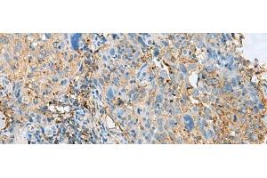 Immunohistochemistry of paraffin-embedded Human cervical cancer tissue using HLA-DPB1 Polyclonal Antibody at dilution of 1:50(x200)