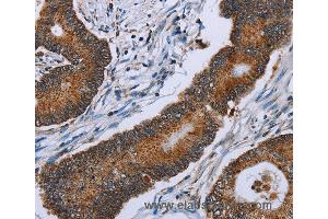 Immunohistochemistry of Human colon cancer using IDH2 Polyclonal Antibody at dilution of 1:60 (IDH2 Antikörper)