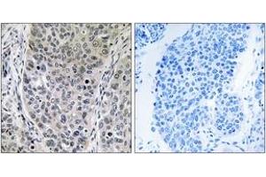 Immunohistochemistry analysis of paraffin-embedded human lung carcinoma tissue, using BRP16 Antibody. (FAM203B Antikörper  (AA 251-300))
