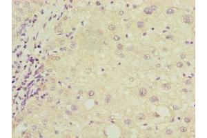 Immunohistochemistry of paraffin-embedded human liver cancer using ABIN7149150 at dilution of 1:100 (COX17 Antikörper  (AA 1-63))