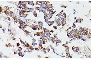Immunohistochemistry of paraffin-embedded Human lung cancer using SUCLG2 Polyclonal Antibody at dilution of 1:100 (40x lens). (SUCLG2 Antikörper)