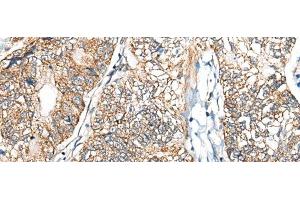 Immunohistochemistry of paraffin-embedded Human gastric cancer tissue using NADK2 Polyclonal Antibody at dilution of 1:40(x200) (NADK2 Antikörper)