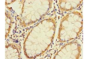 Immunohistochemistry of paraffin-embedded human colon cancer using ABIN7166269 at dilution of 1:100 (UNC93A Antikörper  (AA 374-415))