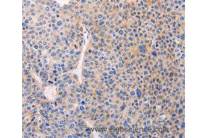 Immunohistochemistry of Human liver cancer using ADCY1 Polyclonal Antibody at dilution of 1:60