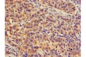 Immunohistochemistry of paraffin-embedded human pancreatic cancer using ABIN7164956 at dilution of 1:100 (PSMA4 Antikörper  (AA 148-184))